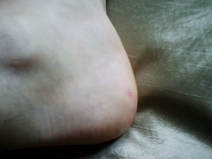 Heel injury